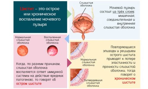 лекарство от цистита у детей от 3 лет