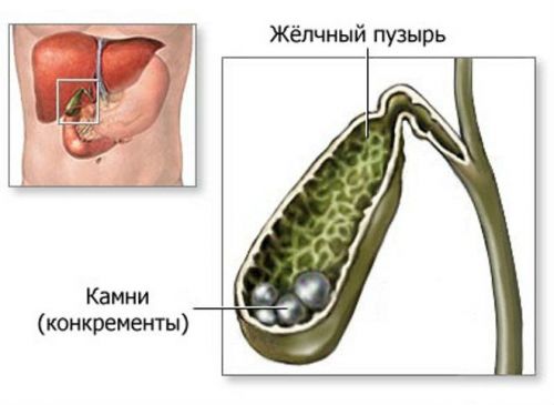 минеральная вода при калькулезном холецистите и примерное питание