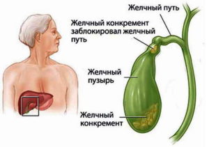 может ли болеть весь живот при холецистите