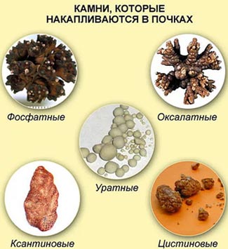 осложнения при мочекаменной болезни