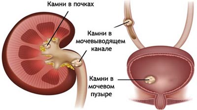 осложнения при мочекаменной болезни