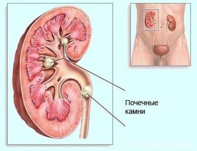можно ли вылечить мочекаменную болезнь у человека