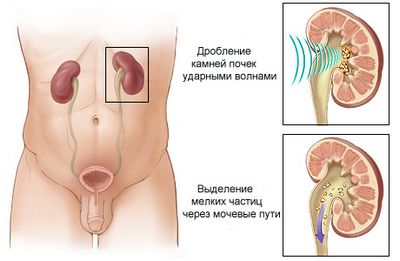можно ли вылечить мочекаменную болезнь у человека