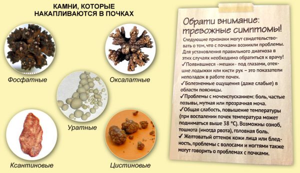 виды камней при мочекаменной болезни и диета