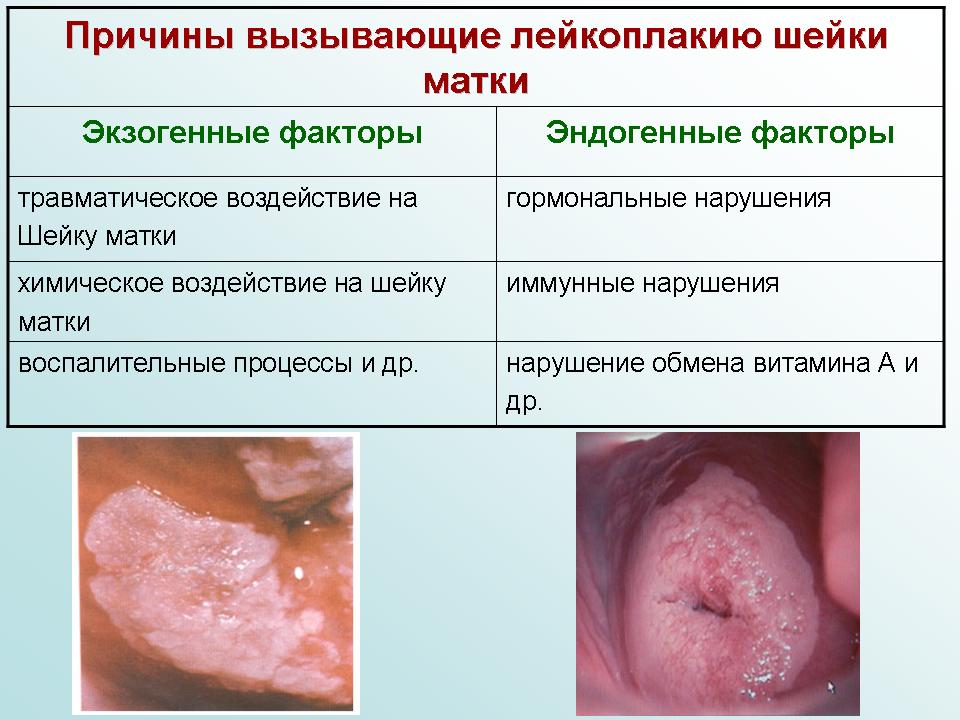 может ли вирус папилломы человека вызвать цистит