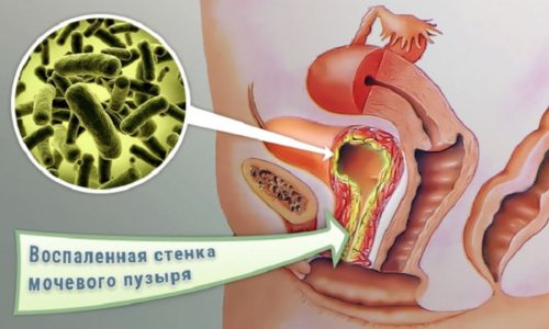 во время овуляции боли как при цистите